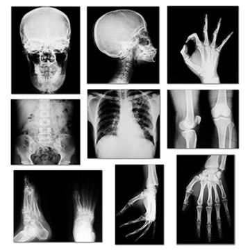 X-Ray Film Cassette 35 X 35cm With Screen